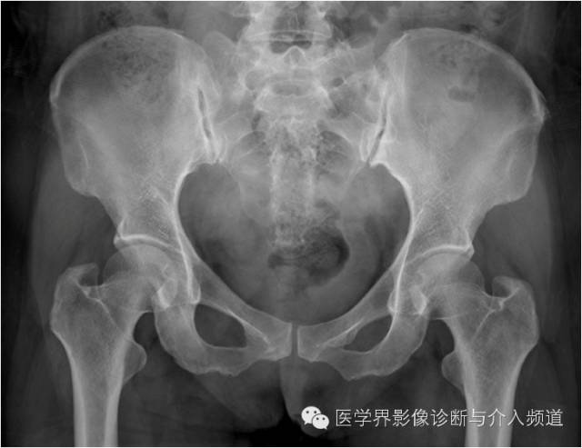 骨盆X片，这些径线你还记得吗？