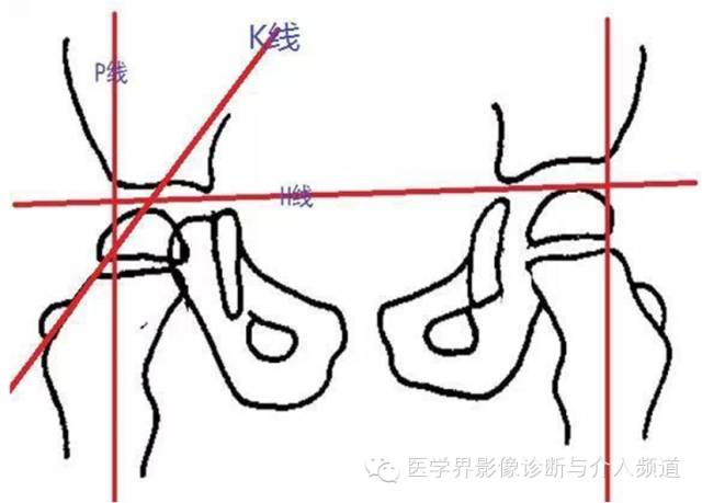 骨盆X片，这些径线你还记得吗？