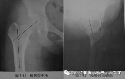 骨盆X片，这些径线你还记得吗？