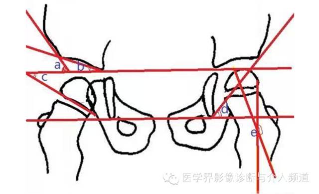 骨盆X片，这些径线你还记得吗？