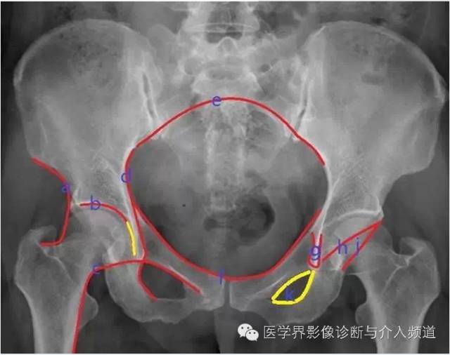 骨盆X片，这些径线你还记得吗？