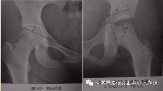 骨盆X片，这些径线你还记得吗？