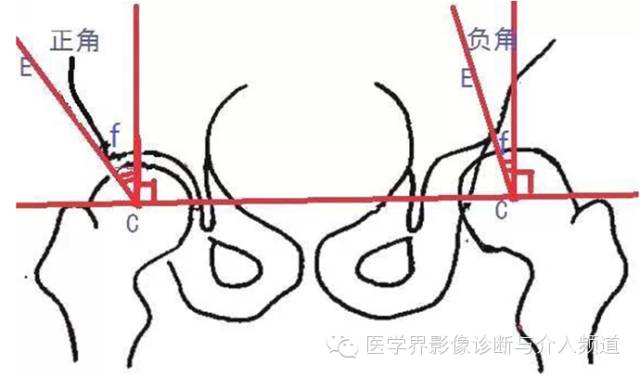 骨盆X片，这些径线你还记得吗？