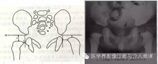 骨盆X片，这些径线你还记得吗？