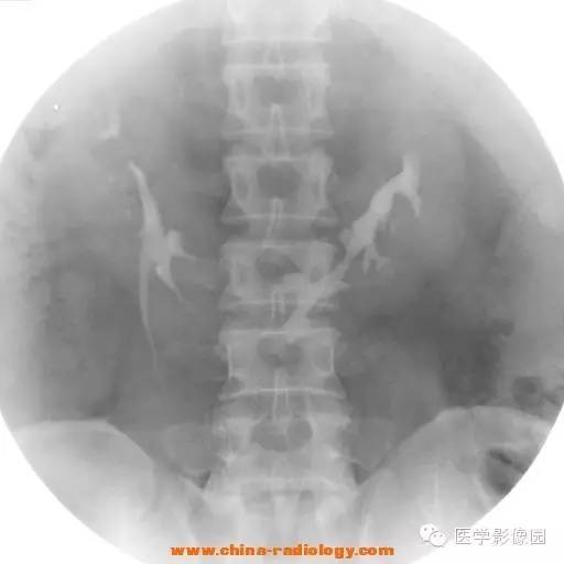 【病例】马蹄肾1例影像表现