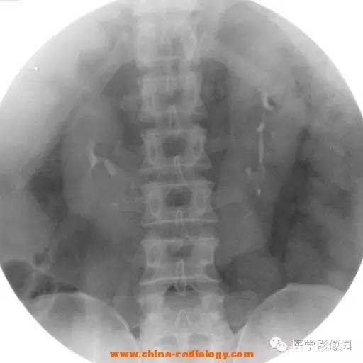 【病例】马蹄肾1例影像表现 【病例】马蹄肾1例影像表现