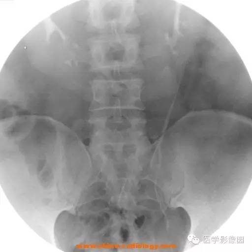 【病例】马蹄肾1例影像表现 【病例】马蹄肾1例影像表现