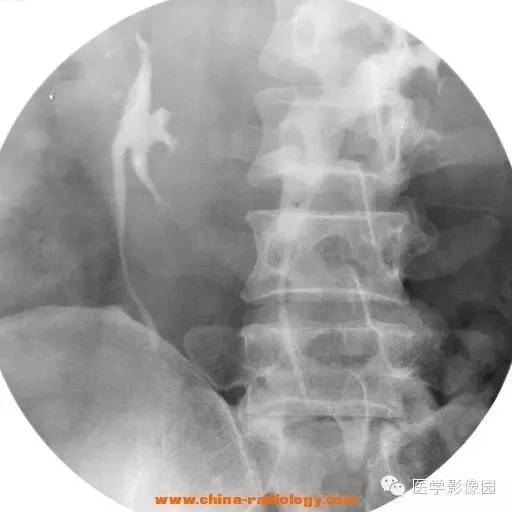 【病例】马蹄肾1例影像表现 【病例】马蹄肾1例影像表现