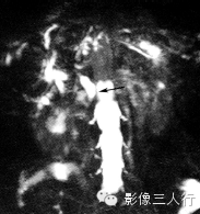 胆管疾病的鉴别诊断