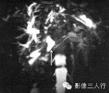 胆管疾病的鉴别诊断 胆管疾病的鉴别诊断