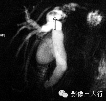 胆管疾病的鉴别诊断 胆管疾病的鉴别诊断