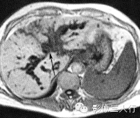 胆管疾病的鉴别诊断 胆管疾病的鉴别诊断