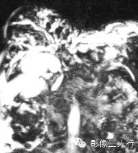 胆管疾病的鉴别诊断 胆管疾病的鉴别诊断