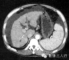 肝硬化的CT报告书写技巧与提示 肝硬化的CT报告书写技巧与提示