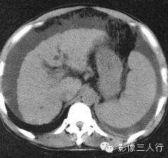 肝硬化的CT报告书写技巧与提示