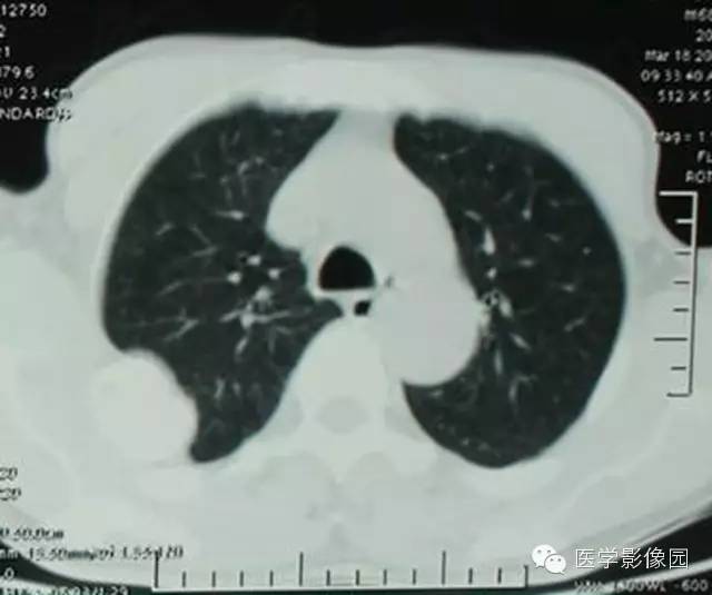 【病例】肋骨血管瘤1例CT影像表现