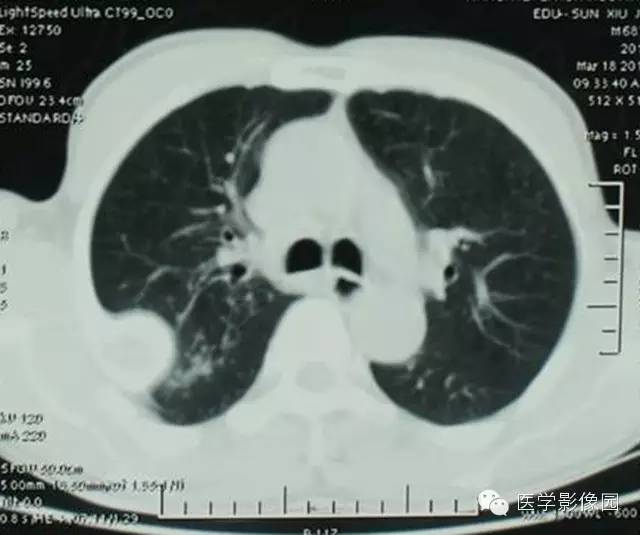 【病例】肋骨血管瘤1例CT影像表现