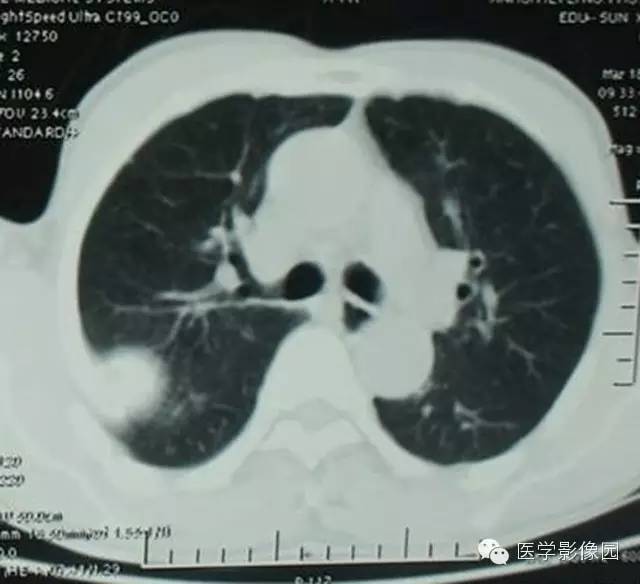 【病例】肋骨血管瘤1例CT影像表现