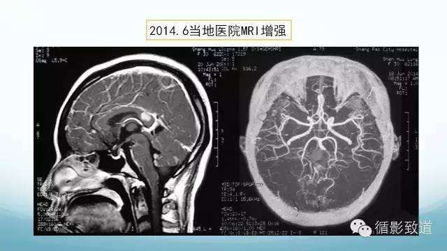 【病例】脑内黑色素瘤转移瘤1例影像表现
