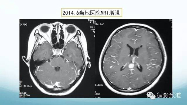 【病例】脑内黑色素瘤转移瘤1例影像表现