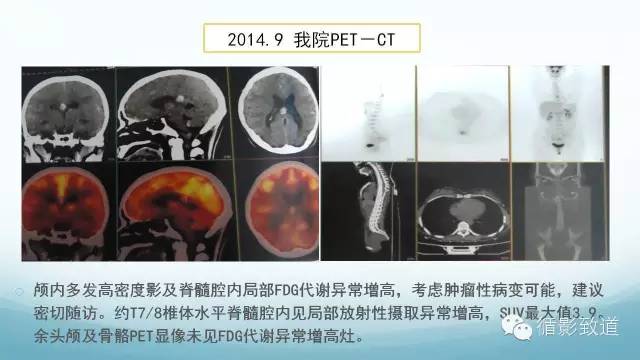 【病例】脑内黑色素瘤转移瘤1例影像表现