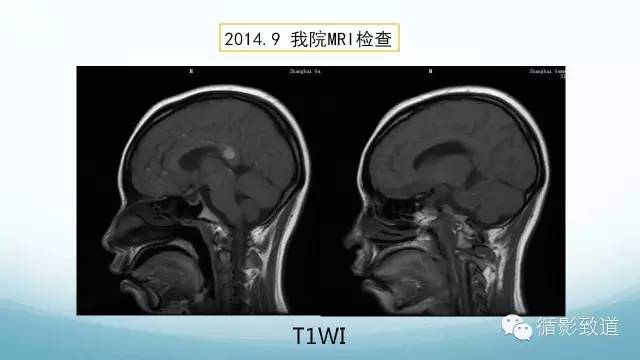 【病例】脑内黑色素瘤转移瘤1例影像表现