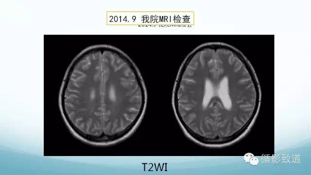 【病例】脑内黑色素瘤转移瘤1例影像表现