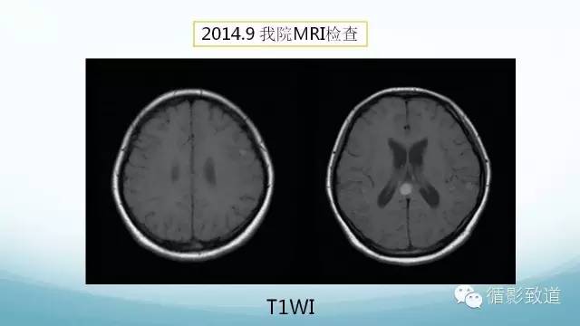 【病例】脑内黑色素瘤转移瘤1例影像表现