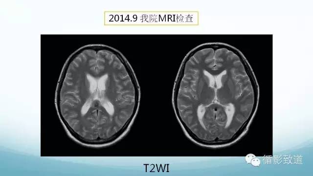 【病例】脑内黑色素瘤转移瘤1例影像表现