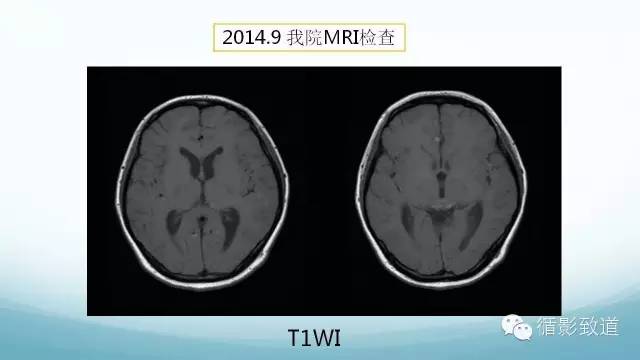 【病例】脑内黑色素瘤转移瘤1例影像表现