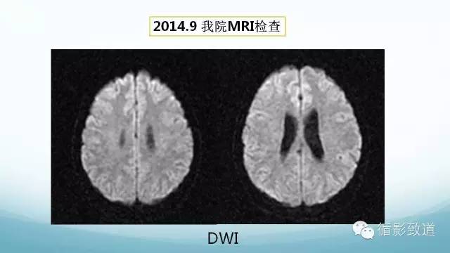 【病例】脑内黑色素瘤转移瘤1例影像表现