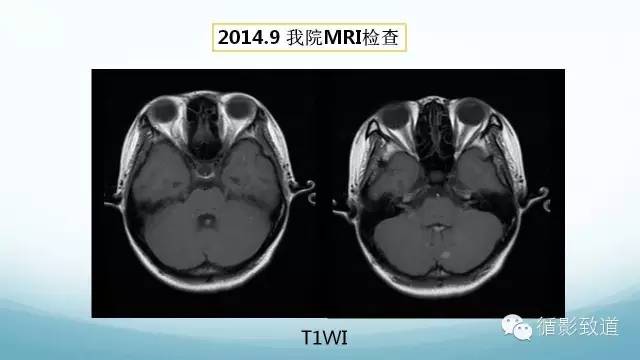 【病例】脑内黑色素瘤转移瘤1例影像表现