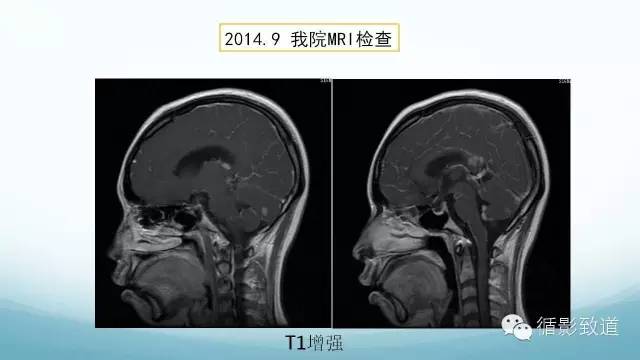 【病例】脑内黑色素瘤转移瘤1例影像表现