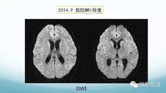 【病例】脑内黑色素瘤转移瘤1例影像表现
