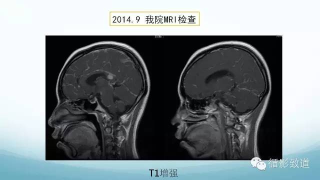 【病例】脑内黑色素瘤转移瘤1例影像表现