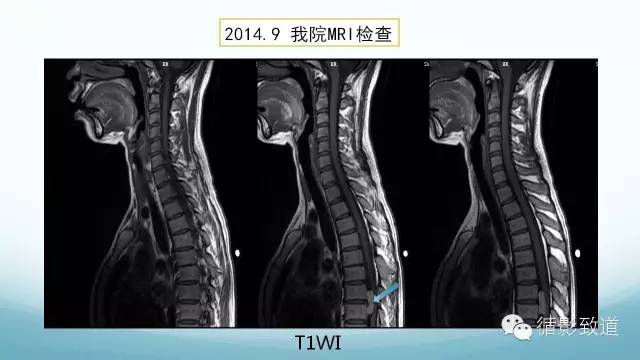 【病例】脑内黑色素瘤转移瘤1例影像表现