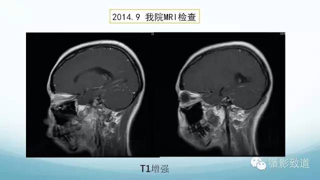 【病例】脑内黑色素瘤转移瘤1例影像表现