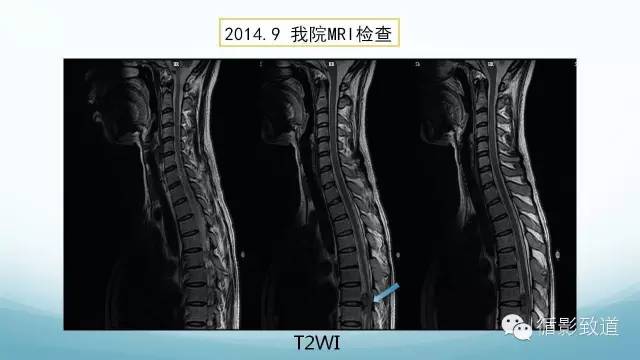 【病例】脑内黑色素瘤转移瘤1例影像表现