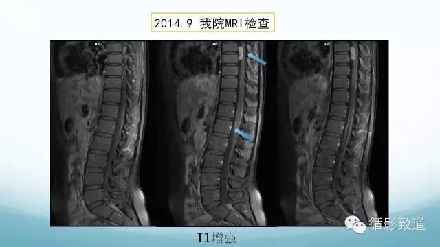 【病例】脑内黑色素瘤转移瘤1例影像表现
