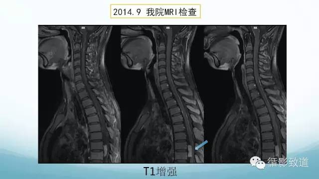 【病例】脑内黑色素瘤转移瘤1例影像表现