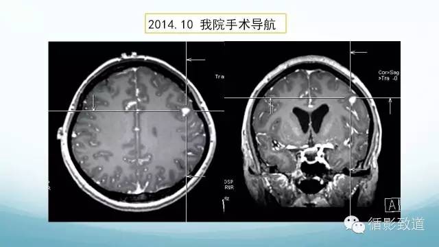 【病例】脑内黑色素瘤转移瘤1例影像表现
