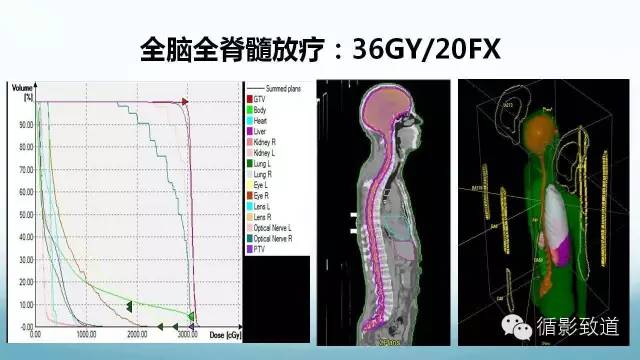 【病例】脑内黑色素瘤转移瘤1例影像表现