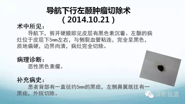 【病例】脑内黑色素瘤转移瘤1例影像表现