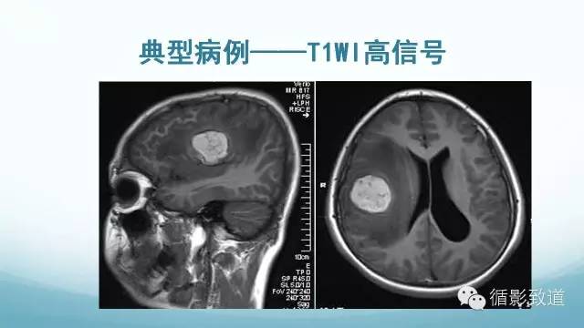 【病例】脑内黑色素瘤转移瘤1例影像表现