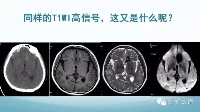 【病例】脑内黑色素瘤转移瘤1例影像表现