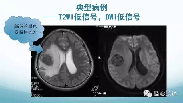 【病例】脑内黑色素瘤转移瘤1例影像表现