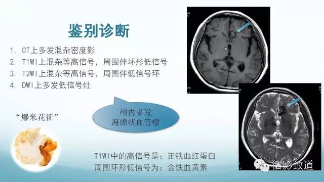 【病例】脑内黑色素瘤转移瘤1例影像表现