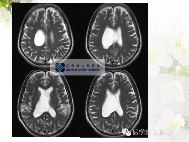 【病例】中枢神经细胞瘤1例MR影像表现
