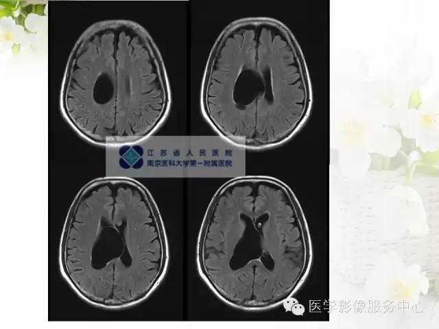 【病例】中枢神经细胞瘤1例MR影像表现 【病例】中枢神经细胞瘤1例MR影像表现