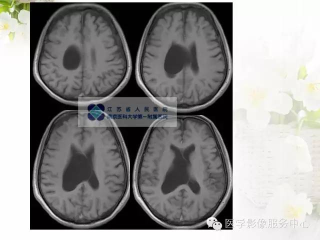 【病例】中枢神经细胞瘤1例MR影像表现 【病例】中枢神经细胞瘤1例MR影像表现